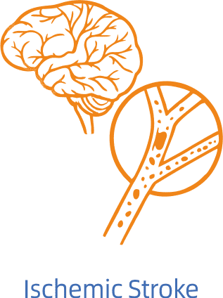 Accident vasculaire c&eacute;r&eacute;bral isch&eacute;mique