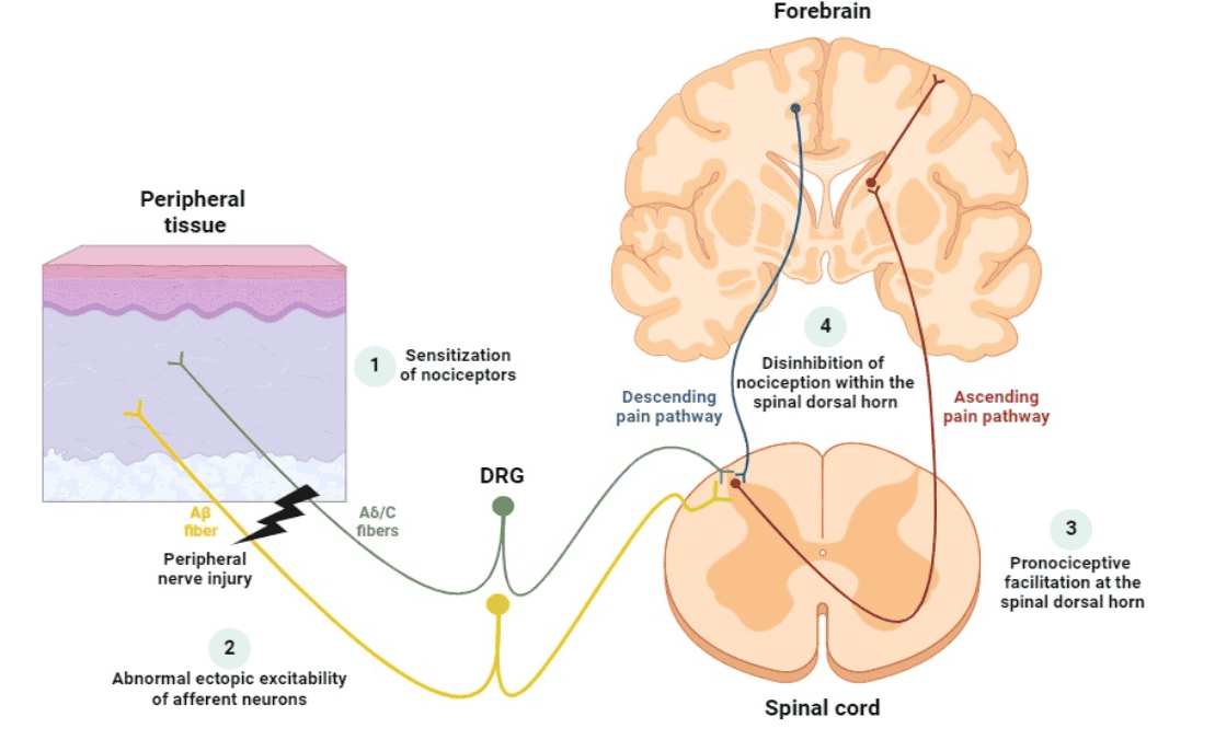 Integrated neuropathic pain pathway 2025