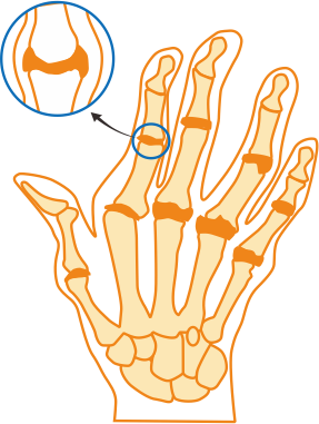 Rheumatoid Arthritis