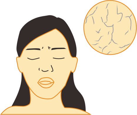 Sjögren’s Syndrome