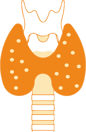 Hyperthyroidism, Graves’ Disease