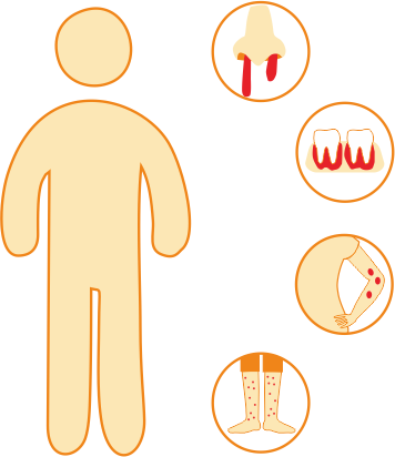 Immune Thrombocytopenia