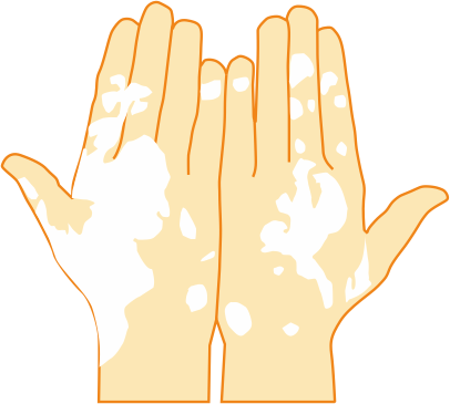 Vitiligo