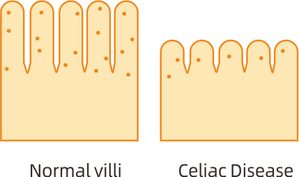 Celiac Disease