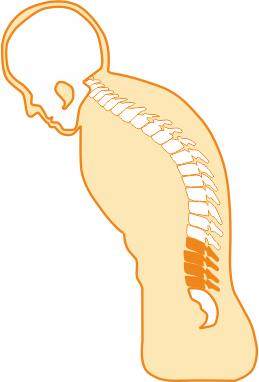 Ankylosing Spondylitis