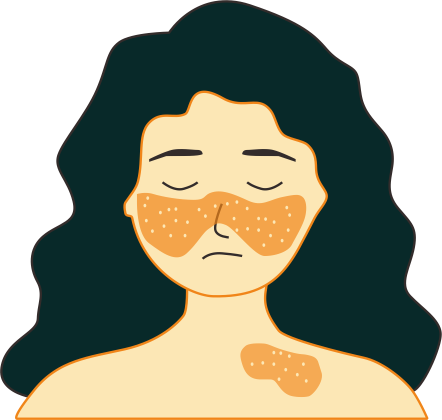 Systemic Lupus Erythematosus