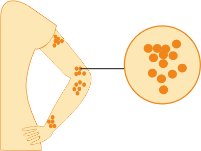 Idiopathic Inflammatory Myopathies