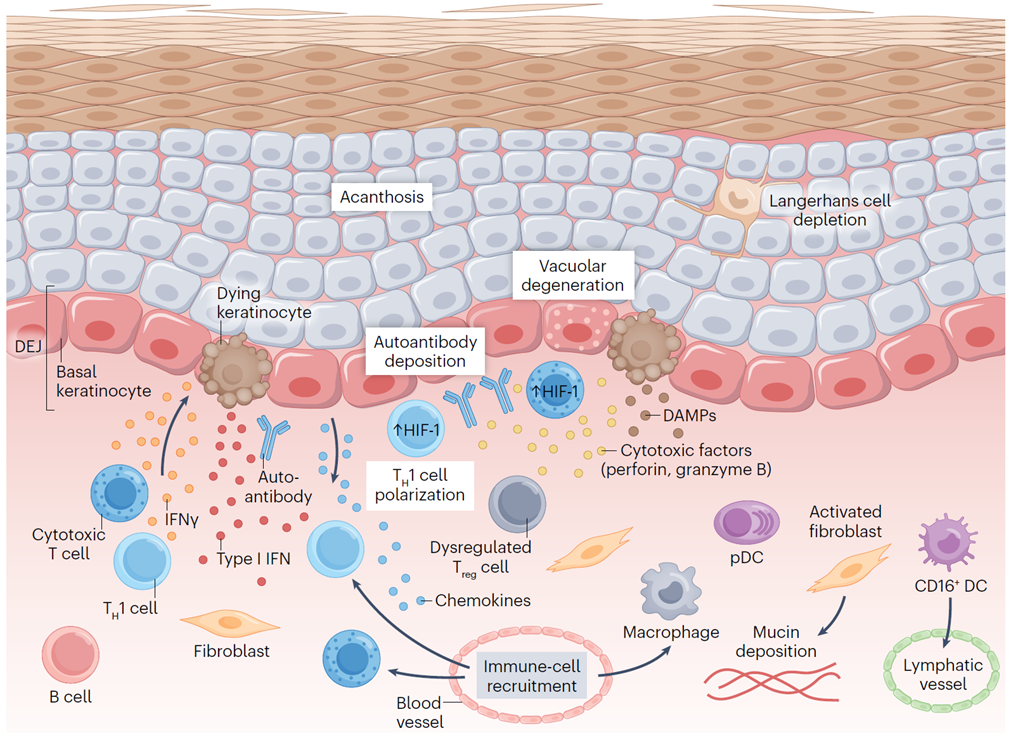 Inflammatory pathways in lupus skin lesions