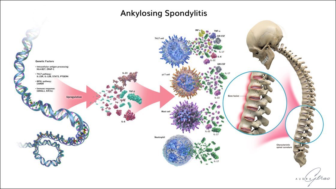  Ankylosing Spondylitis