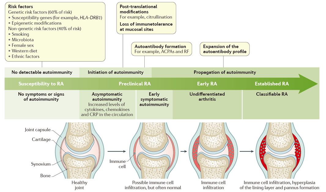 Development and progression of rheumatoid arthritis