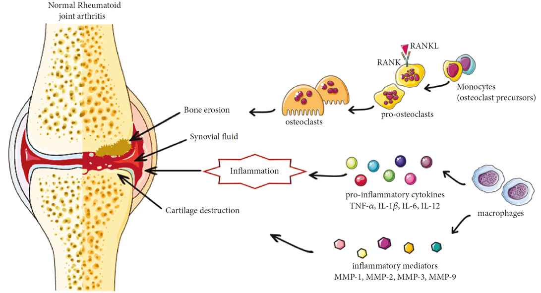 Schematic representation of rheumatoid arthritis pathogenesis