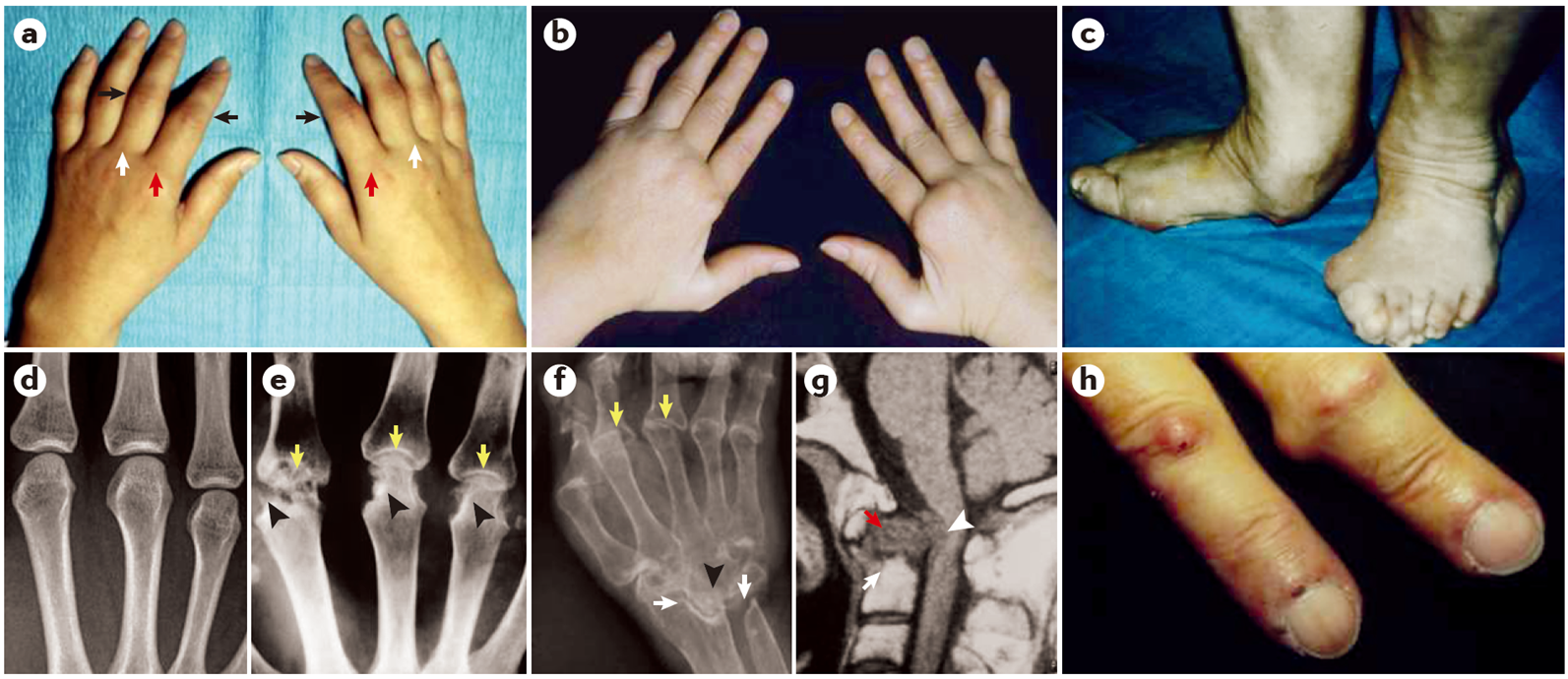 Clinical manifestations of rheumatoid arthritis