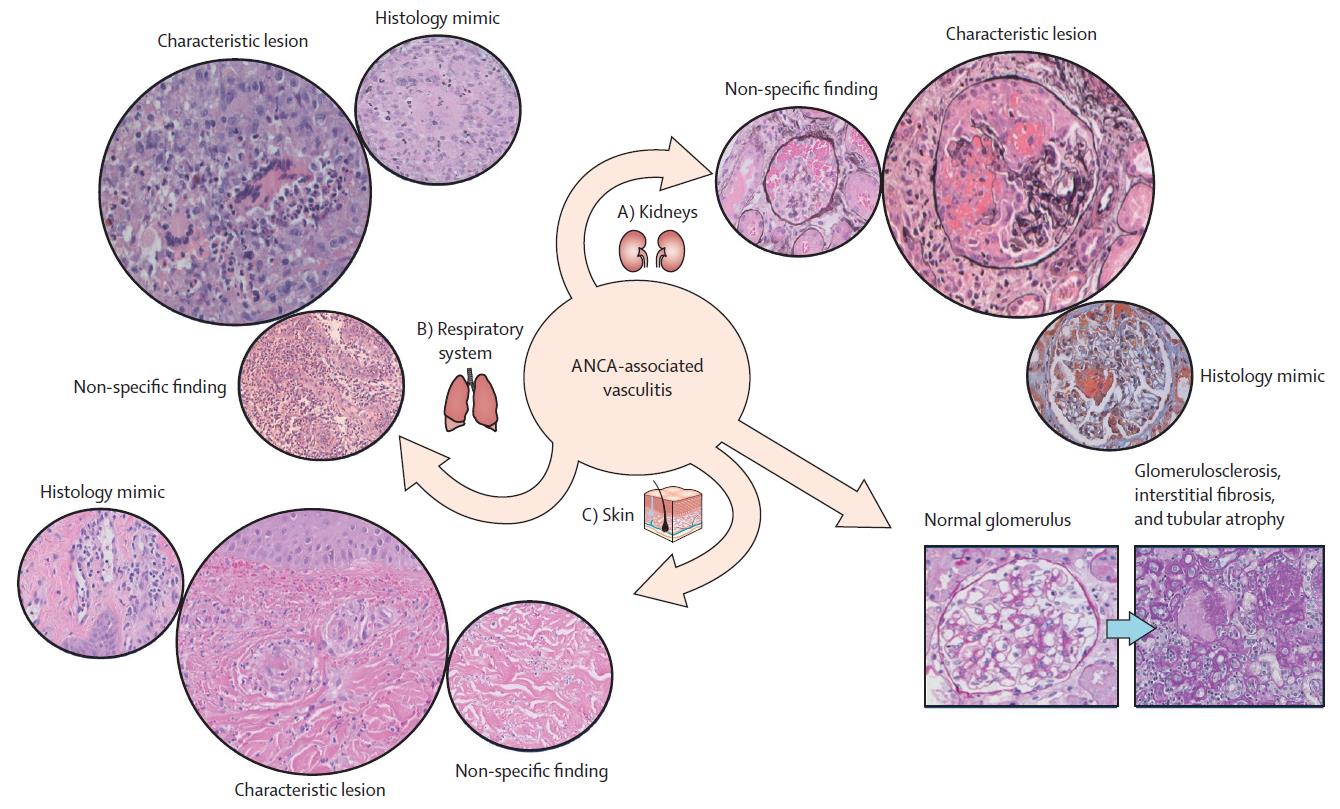 The effect of ANCA-associated vasculitis