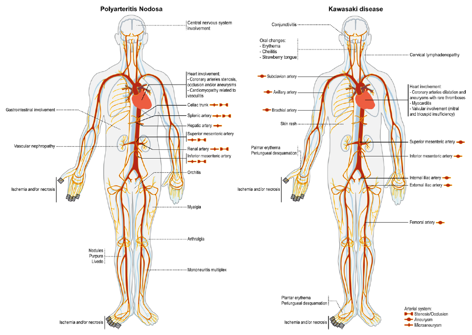 Representative pattern of predominant vascular and organ lesions in medium-vessel vasculitis