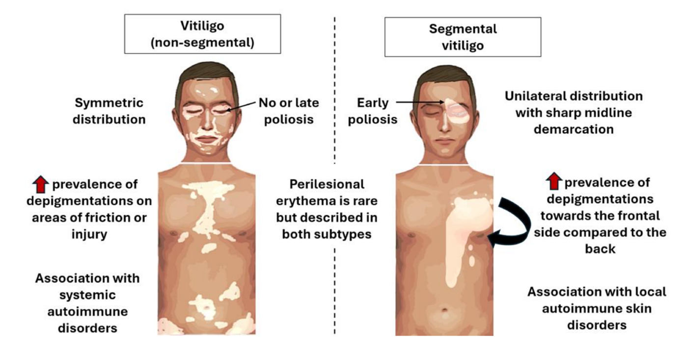 Clinical manifestations of vitiligo