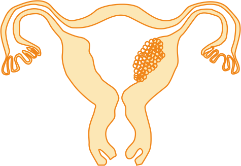 Endometrial Cancer
