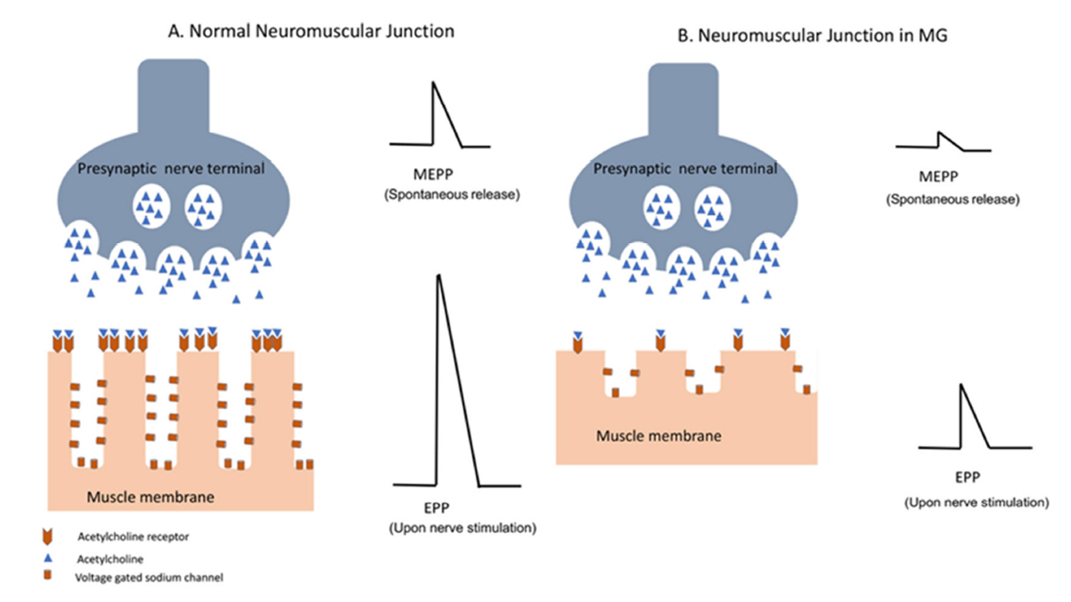 Neuromuscular transmission in a healthy individual and a patient with myasthenia gravis