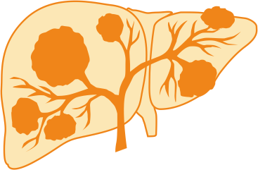 Hepatocellular Carcinoma