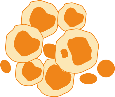 Acute Myeloid Leukemia, AML