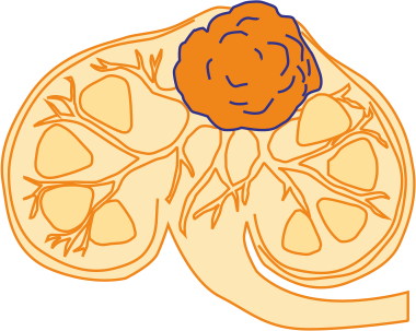 Renal Cell Carcinoma