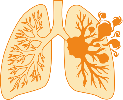 Lung Cancer