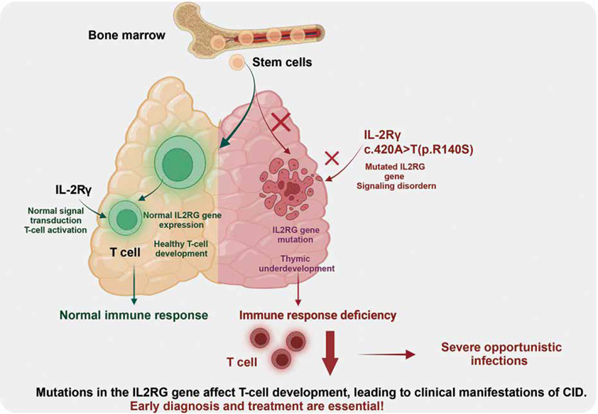 Mechanism of Novel IL2RG Gene Mutation in Primary Combined Immunodeficiency